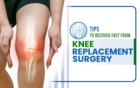 Tips To Recover Fast From Knee Replacement Surgery