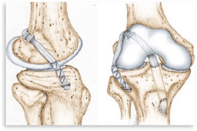 Expert Ligament Surgery at Orthopedic Hospital in Jaipur for joint pain and injuries.