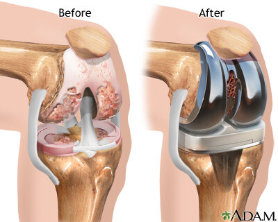 Robotic-knee-surgery