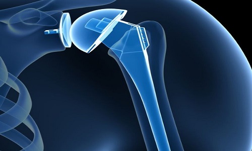 shoulder-replacement-surgery